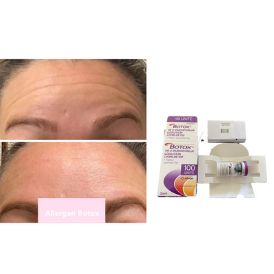 Allergan s 100iu Toksyna botulinowa typu A przeciw zmarszczkom