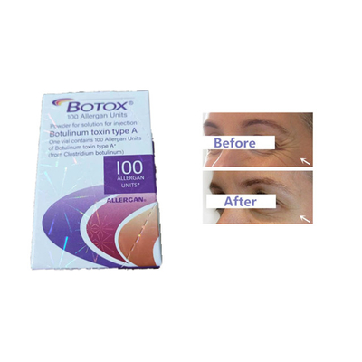 Allergan Botox Injection Toksyna botulinowa 100 jednostek Zmarszczki na czole