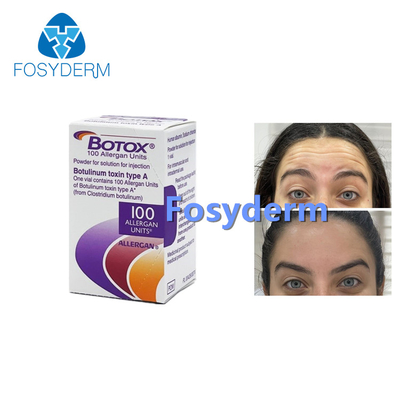 100 jednostek toksyny botulinowej Allergan do usuwania zmarszczek na twarzy Botox typu A