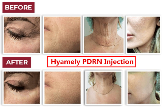Hyamely Cell Regation Skin Booster Serum PDRN do iniekcji do wybielania szyi