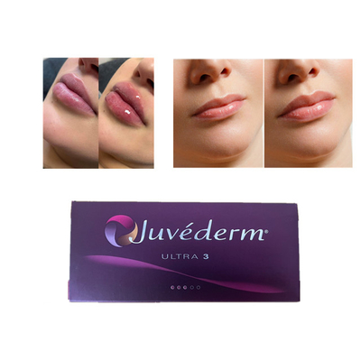 Juvederm Kwas hialuronowy Wypełniacz skórny Przeciwzmarszczkowy wypełniacz do ust
