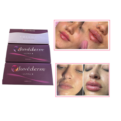 Wstrzykiwania do pielęgnacji skóry Plumper do ust Juvederm Kwas hialuronowy Wypełniacz skórny do twarzy