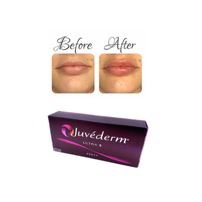Żel wypełniający skórę z kwasem hialuronowym do wstrzykiwań Juvederm