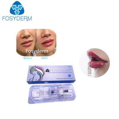 1ml wypełniacze do ust z kwasem hialuronowym Derm Lip Enhancement Injection dla kobiet