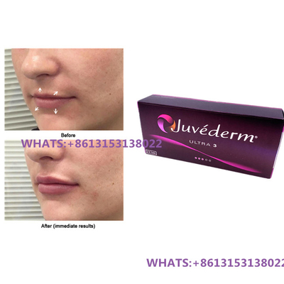Juvederm wypełniacz skórny do ust Juvederm Ultra3 Ultra4 wypełniacze strzykawkę wstępnie napełnioną