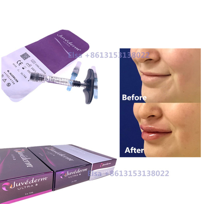 2 × 1 ml Wstrzykiwacz wypełniacz skórny Juvederm Strzykawkę Ultra3 Ultra4 Objętość
