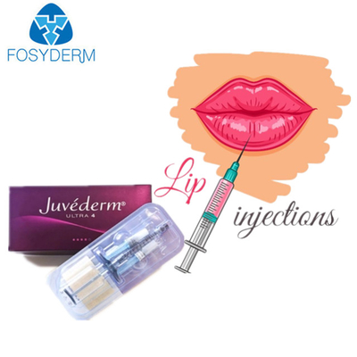 Juvederm Ultra 3 Wypełniacz skórny z kwasem hialuronowym do ust