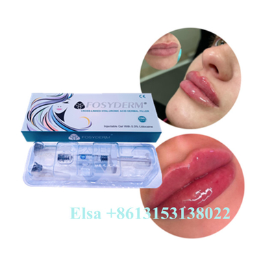 Kwas Hialuronowy Żel Wstrzykiwany Juvederm Wypełniacz Ust Ce Anti Aging 1ml 2ml 5ml