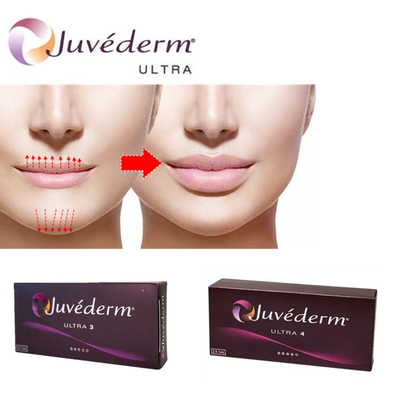 Juvederm Ultra3 Filler z kwasem hialuronowym do warg Żel do wstrzykiwań skórnych, wypełniony