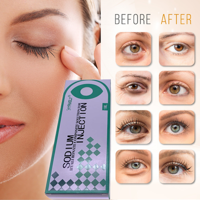 Hyamely Removing Dark Circles Wstrzykiwanie Wypełnianie Doliny Łez 1ml