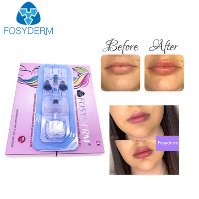 Certyfikat CE 1ml Deep Hyaluronic Acid Derm HA Dermal Filler do ust