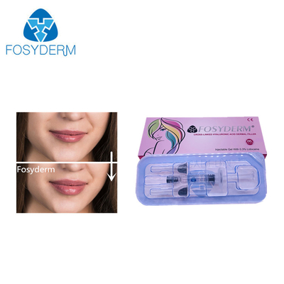2 ml wypełniacza kwas hialuronowy wypełniacz skórny do rozszerzania twarzy, nosa, warg 24 mg/ ml