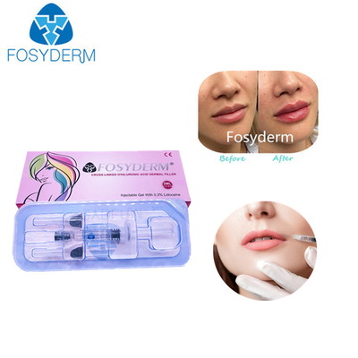 2 Ml Acid Hyaluronic Cross Linked Dermal Filler Lip Filler Injections