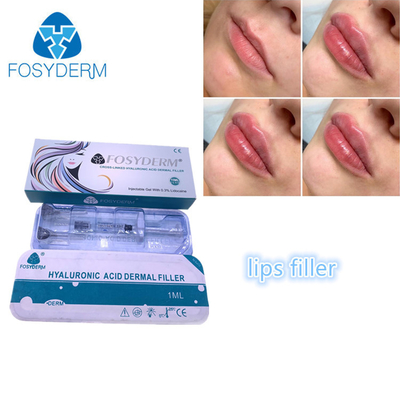 Wypełniający zastrzyk do twarzy Fosyderm Fosyderm Wypełniacze do ust z kwasem hialuronowym 1ml
