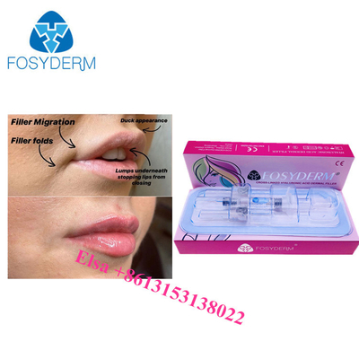 Wstrzykiwanie kwasu hialuronowego 1 ml 2 ml 5 ml